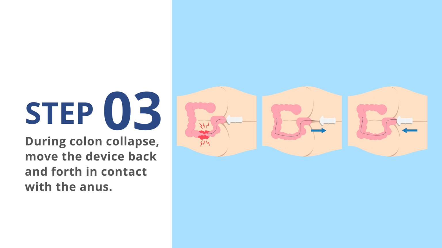 AIR ASSIST 3 STEP PROCESS.pptx (2)